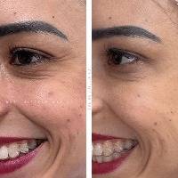 Rejuvenescimento Facial