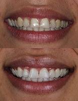 Clareamento Dental